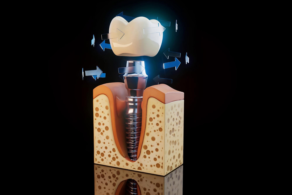 freepik_dental_implant