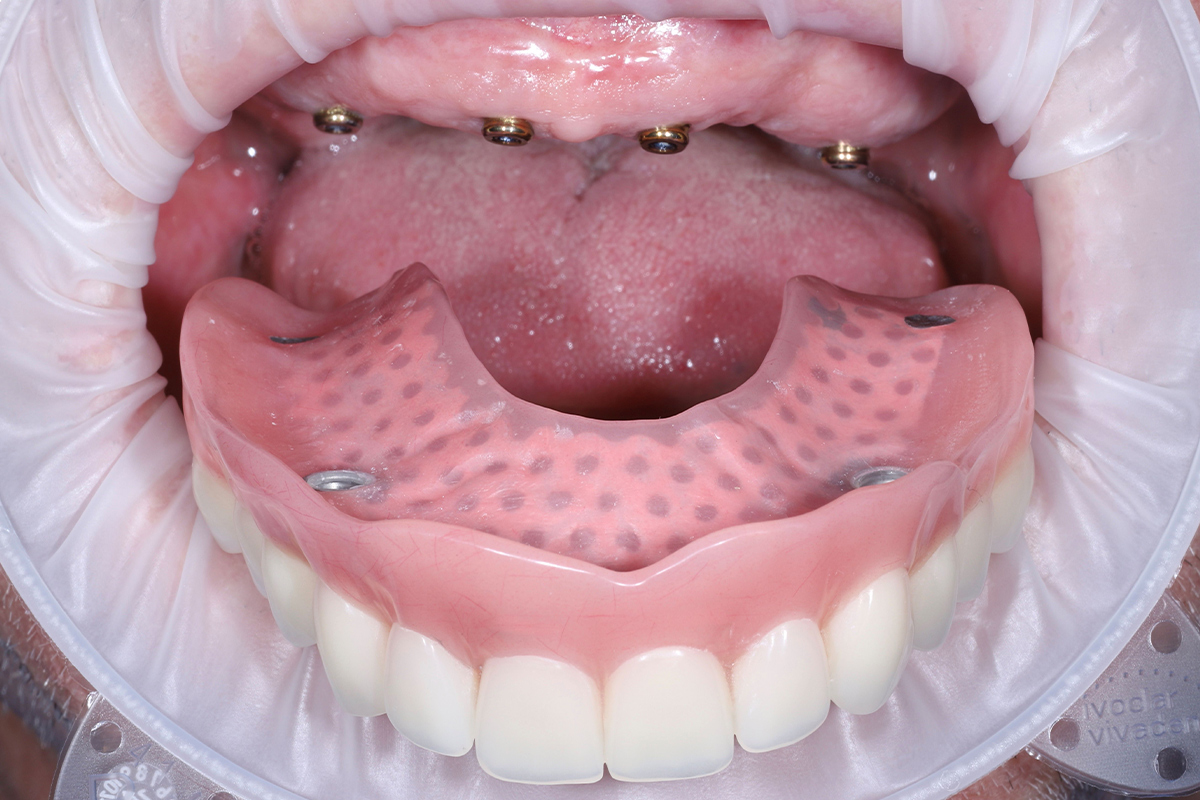 2_happydent_231026