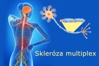 Podceňovanie telesných príznakov sklerózy multiplex