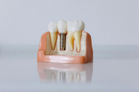 Zubné implantáty - prirodzený úsmev vďaka špičkovej dentálnej technológii