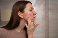 Kuperóza a rosacea